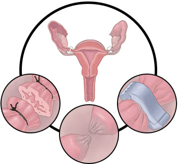 circles_tubal_ligation