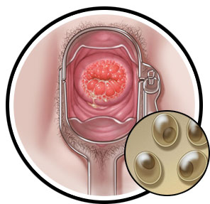 circles_chlamydia-female