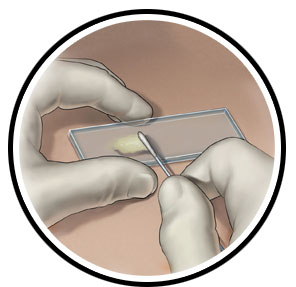 circles_chlamydia-swab-fem