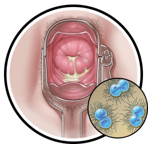 circles_gonorrhea-female