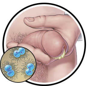 circles_gonorrhea-male