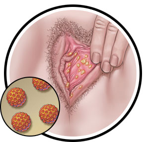 Hpv warts and cancer
