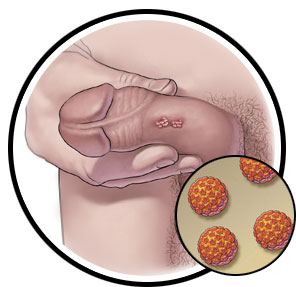 human papillomavirus male symptoms