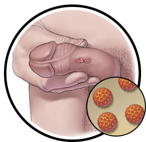 squamous papilloma esophagus hpv medicamente vierme ca profilaxie